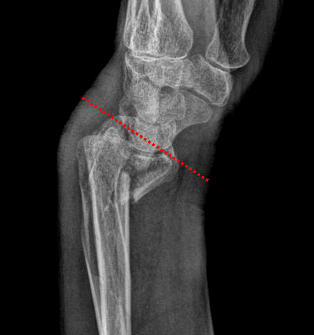 Smith fracture with volar displacement and volar angulation of the distal radial articular surface (red dotted line).
