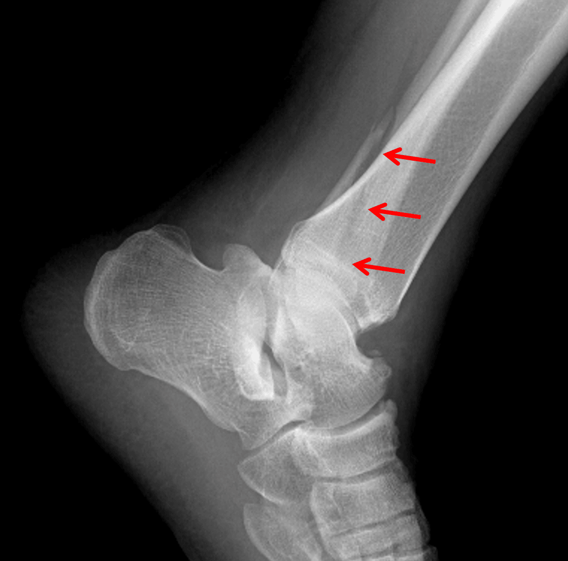 Red arrows: Weber B distal fibular fracture, which is actually best seen on the lateral view in this patient.