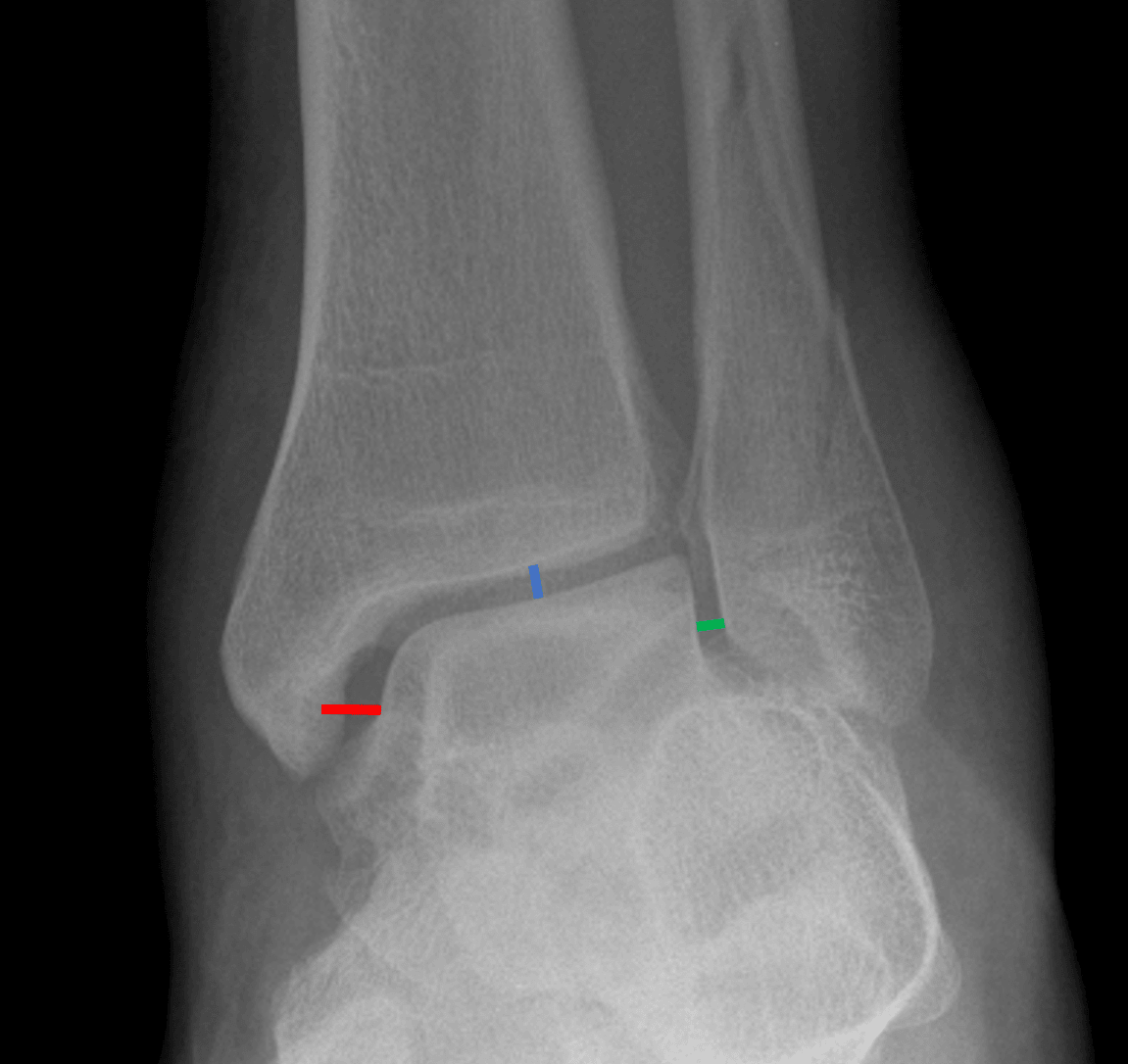 Medial clear space widening. The medial clear space (red line) should not be wider than the other aspects of the ankle mortise (blue and green lines).