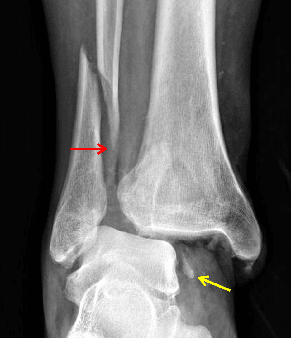 Weber type C fibular fracture (red arrow). Medial malleolar avulsion fracture remains associated with the talus (yellow arrow).