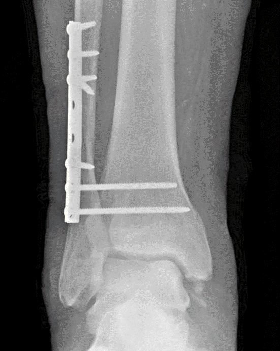 Postoperative radiograph in this patient showing fixation of the fibula and two syndesmotic screws.