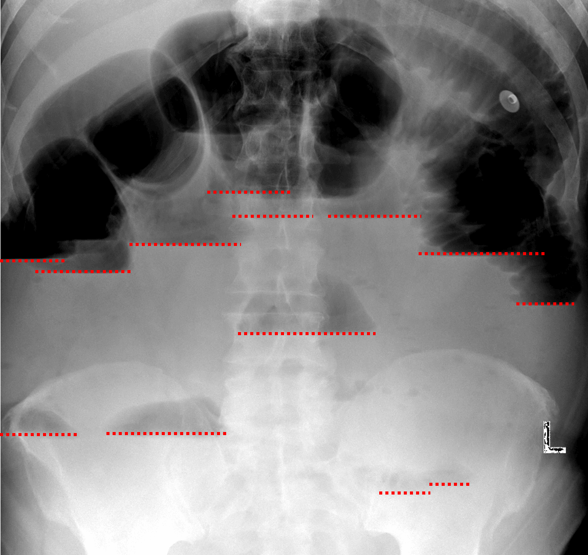 Small bowel obstruction. Red dotted lines highlight many air-fluid levels at different levels in the abdomen on upright imaging.