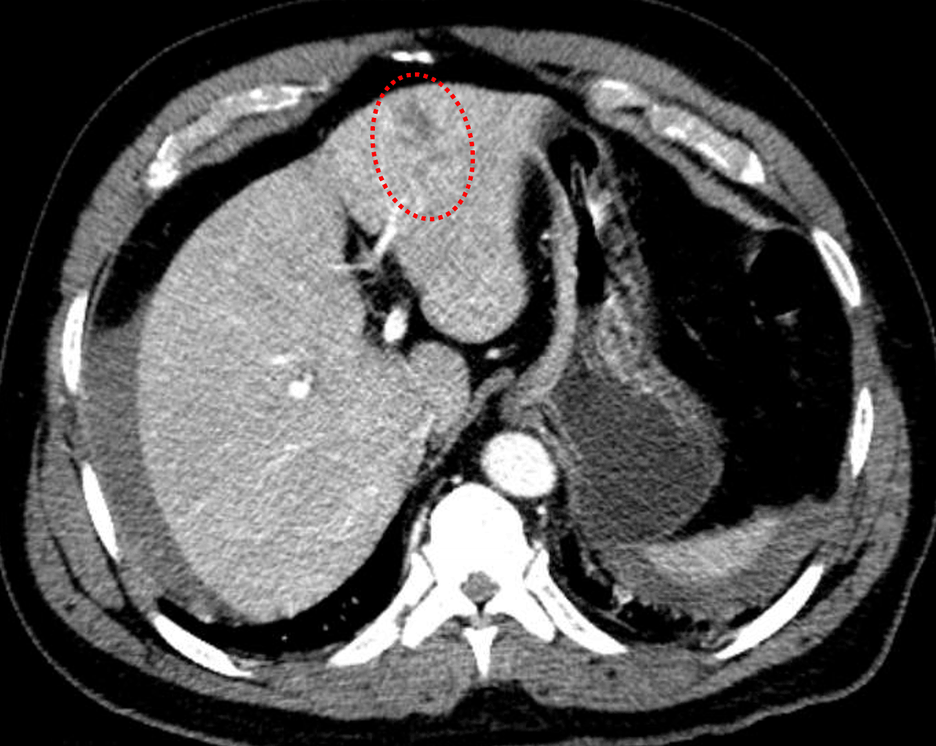 Red outline: hepatic laceration in segment 4 measuring greater than 3 cm in depth.