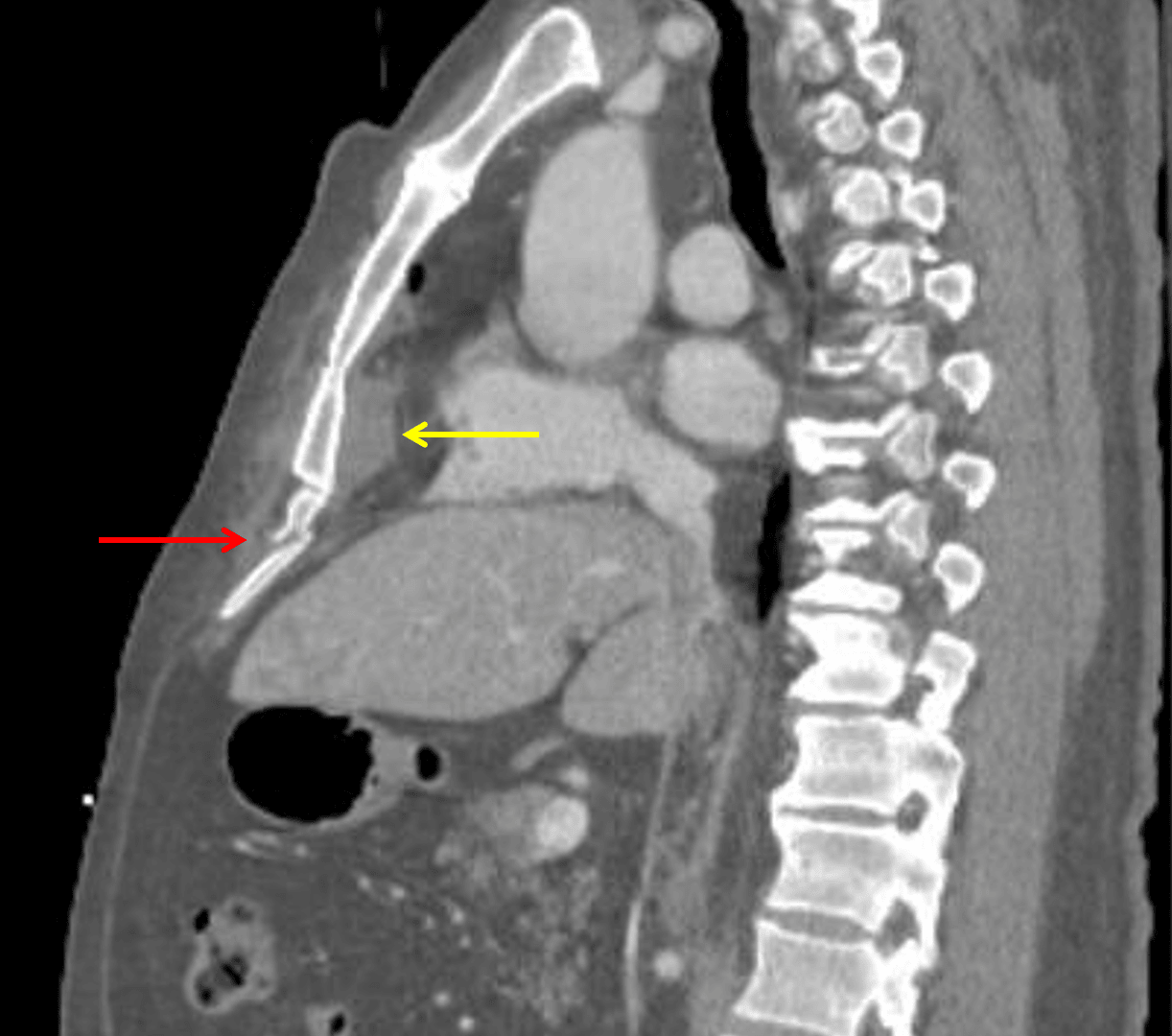 Xiphoid process fracture (red arrow) and subjacent mediastinal hematoma (yellow arrow).