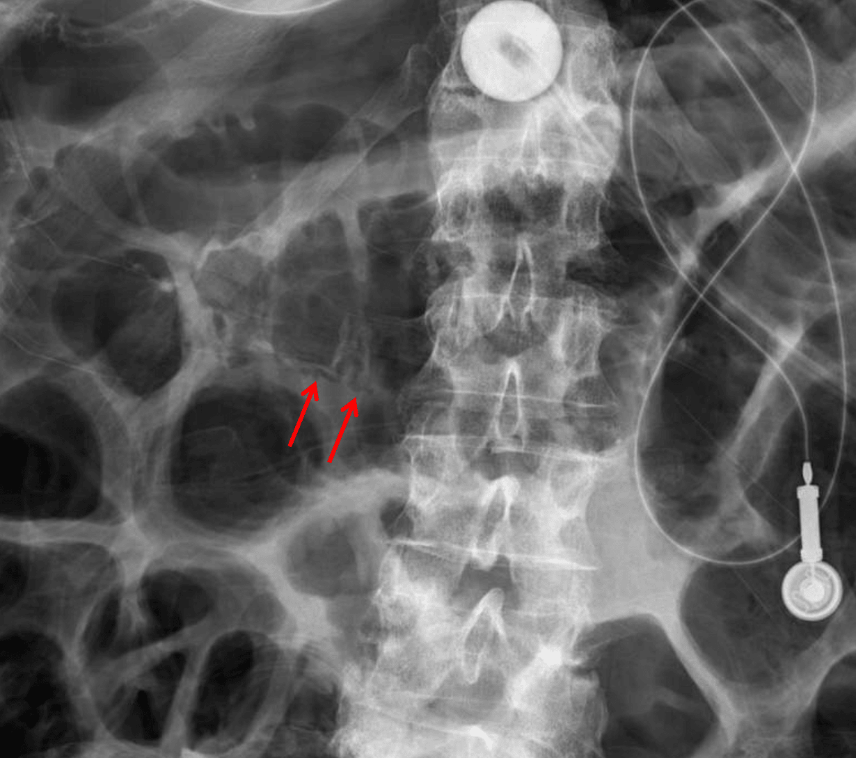 Linear lucency along the inferior wall of the proximal transverse colon concerning for pneumatosis (red arrows).