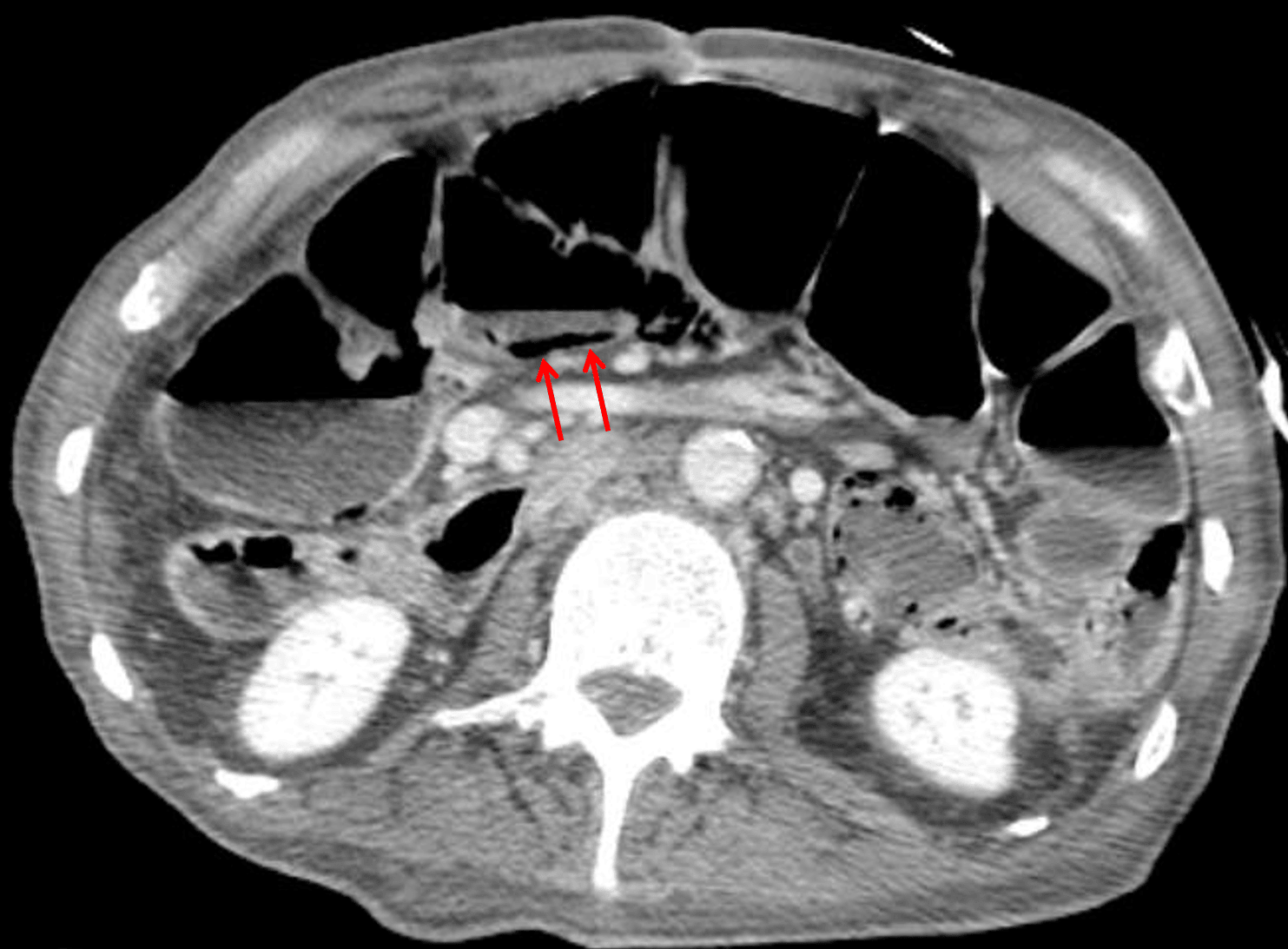 Pneumatosis of the proximal transverse colon confirmed on the subsequent CT (red arrows).