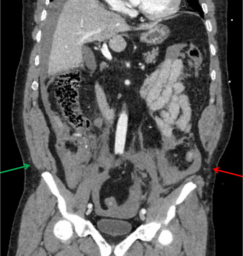 Traumatic herniation of the abdominal wall musculature from the left iliac crest (red arrow) compared to the normal appearance on the right (green arrow).