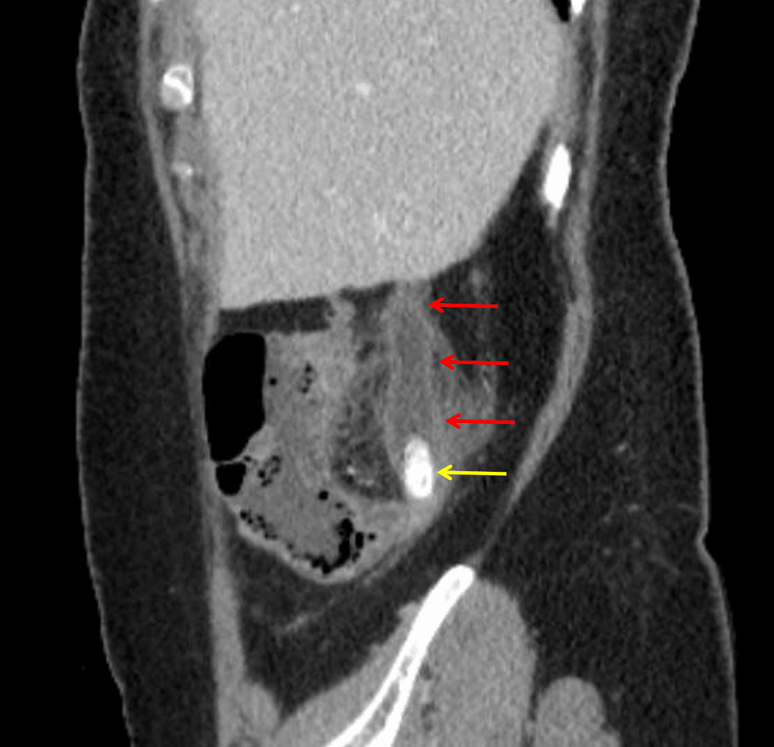 Acute appendicitis: dilated appendix with wall thickening and hyperenhancement (red arrows) and appendicoliths in the base of the appendix (yellow arrow).