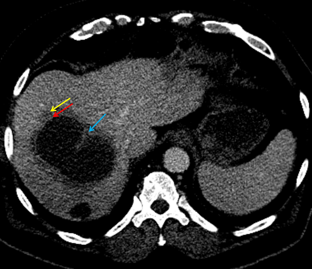 Hepatic abscess showing the double target sign with low density internally surrounded by a thin inner enhancing rim (red arrow) and ill-defined outer low density rim (yellow arrow). Blue arrow indicates an internal septation.