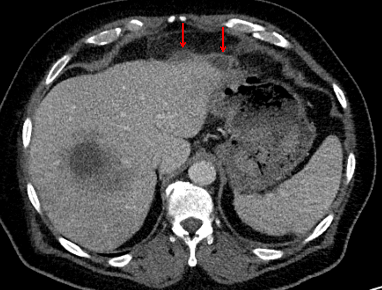 Red arrows: additional smaller subcapsular abscesses.
