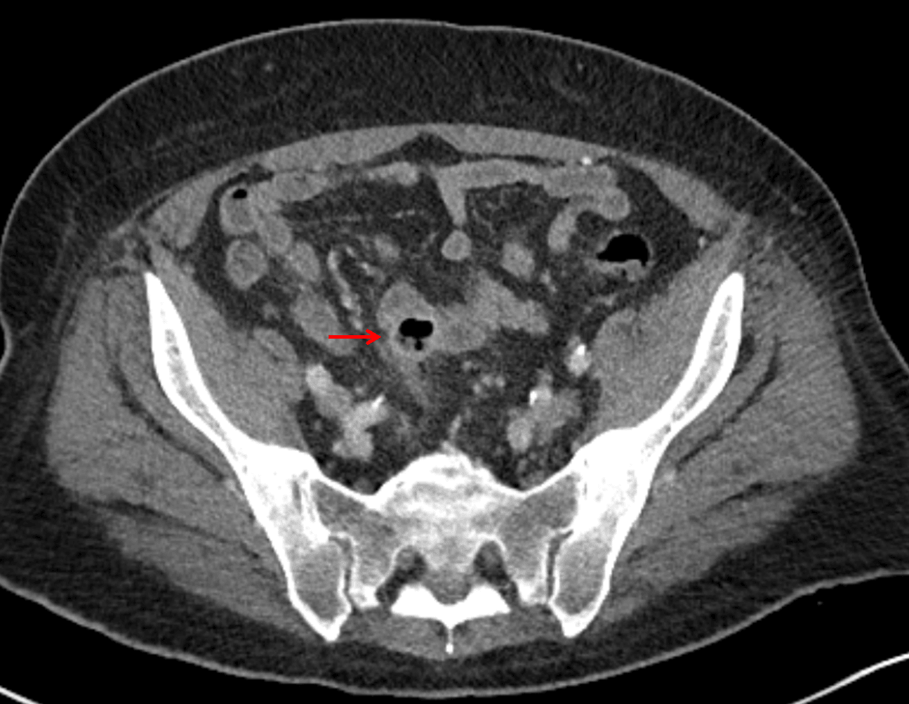 Red arrow: focal contained perforation associated with diverticulitis.
