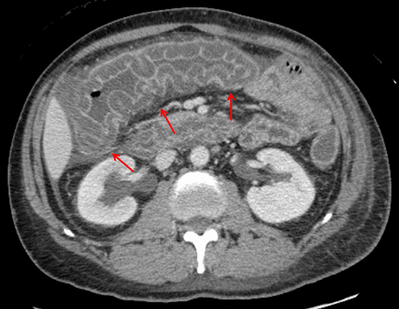 Lupus vasculitis: marked submucosal edema at the hepatic flexure and transverse colon resulting in a thumbprinting appearance of the mucosa (red arrows).