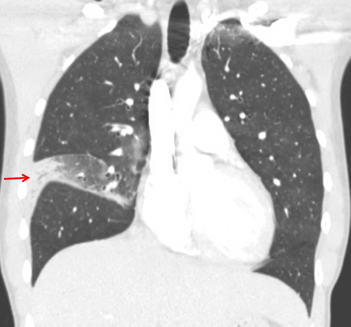 Lobar pneumonia: consolidation in the lateral segment of the right middle lobe with associated volume loss in the right middle lobe.