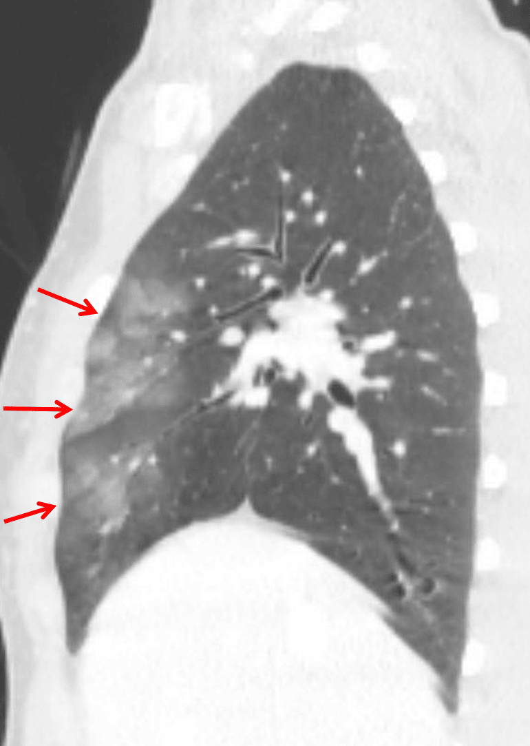 Pulmonary contusion: groundglass opacities in the anterior aspects of the right upper and middle lobes (red arrows).