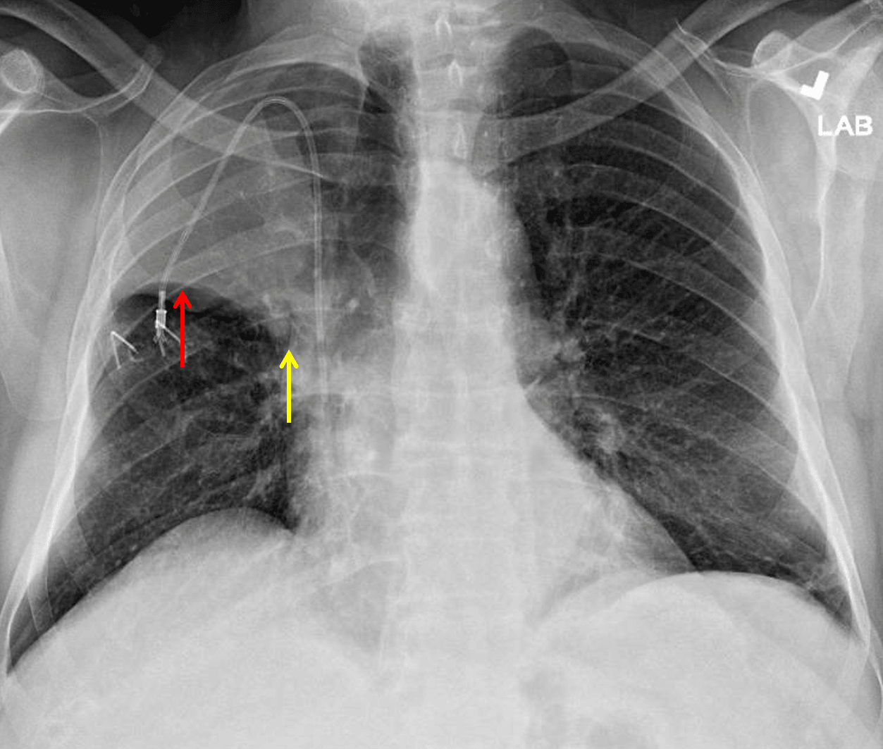 Right upper lobe collapse. The minor fissure is elevated laterally (red arrow) but not as elevated centrally (yellow arrow) raising concern for a perihilar mass.