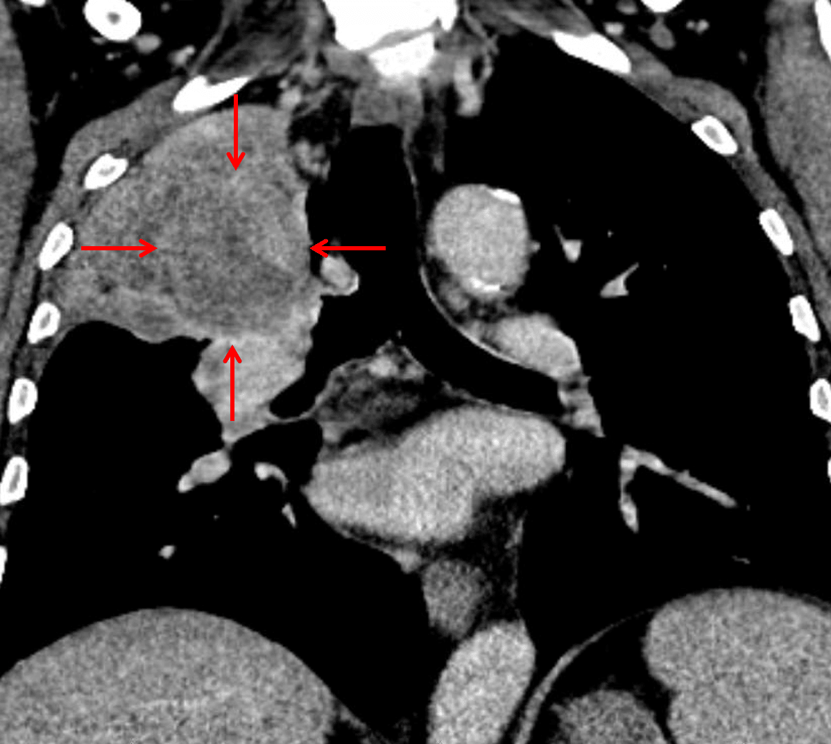 Subsequent CT confirmed the presence of a suprahilar mass with bronchial invasion (red arrows), though the mass is difficult to distinguish from the adjacent atelectatic lung.