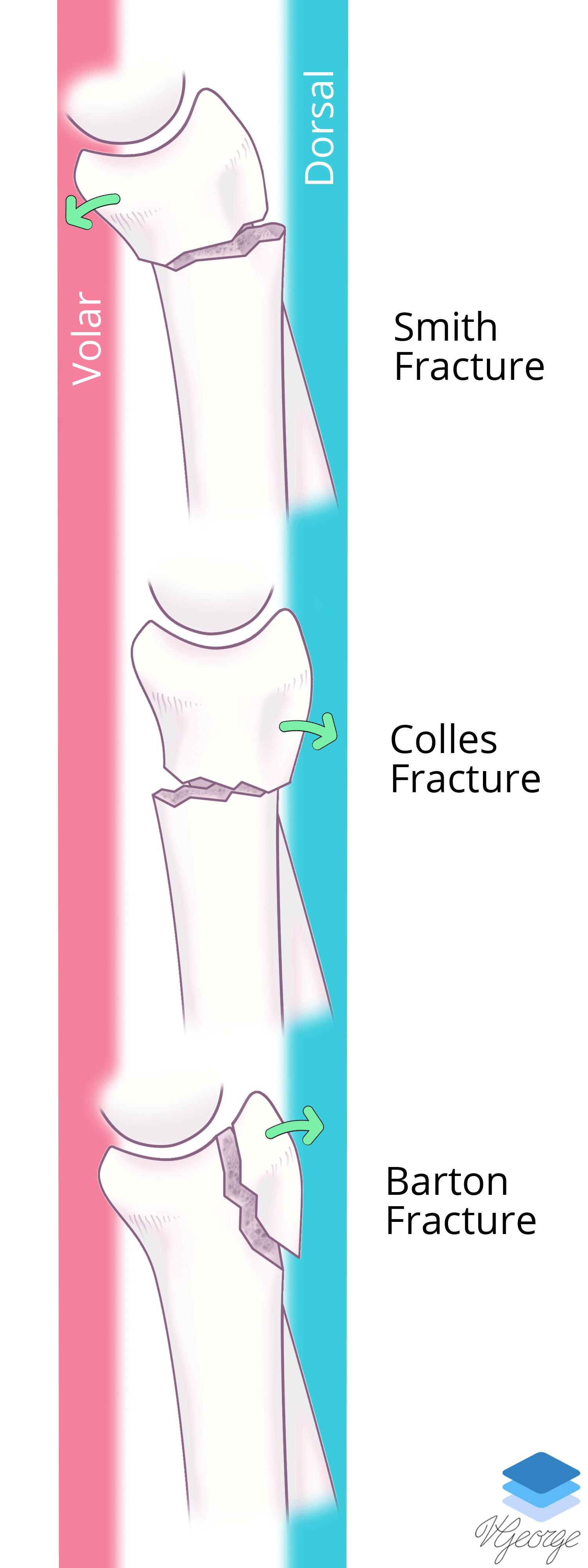 Types of distal radial fractures.