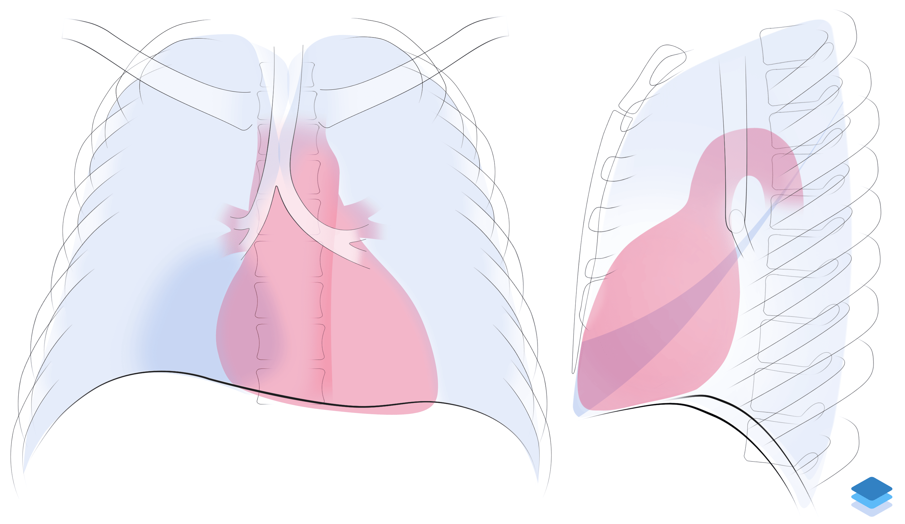 Right middle lobe collapse. Illustration by Valerie George, MD