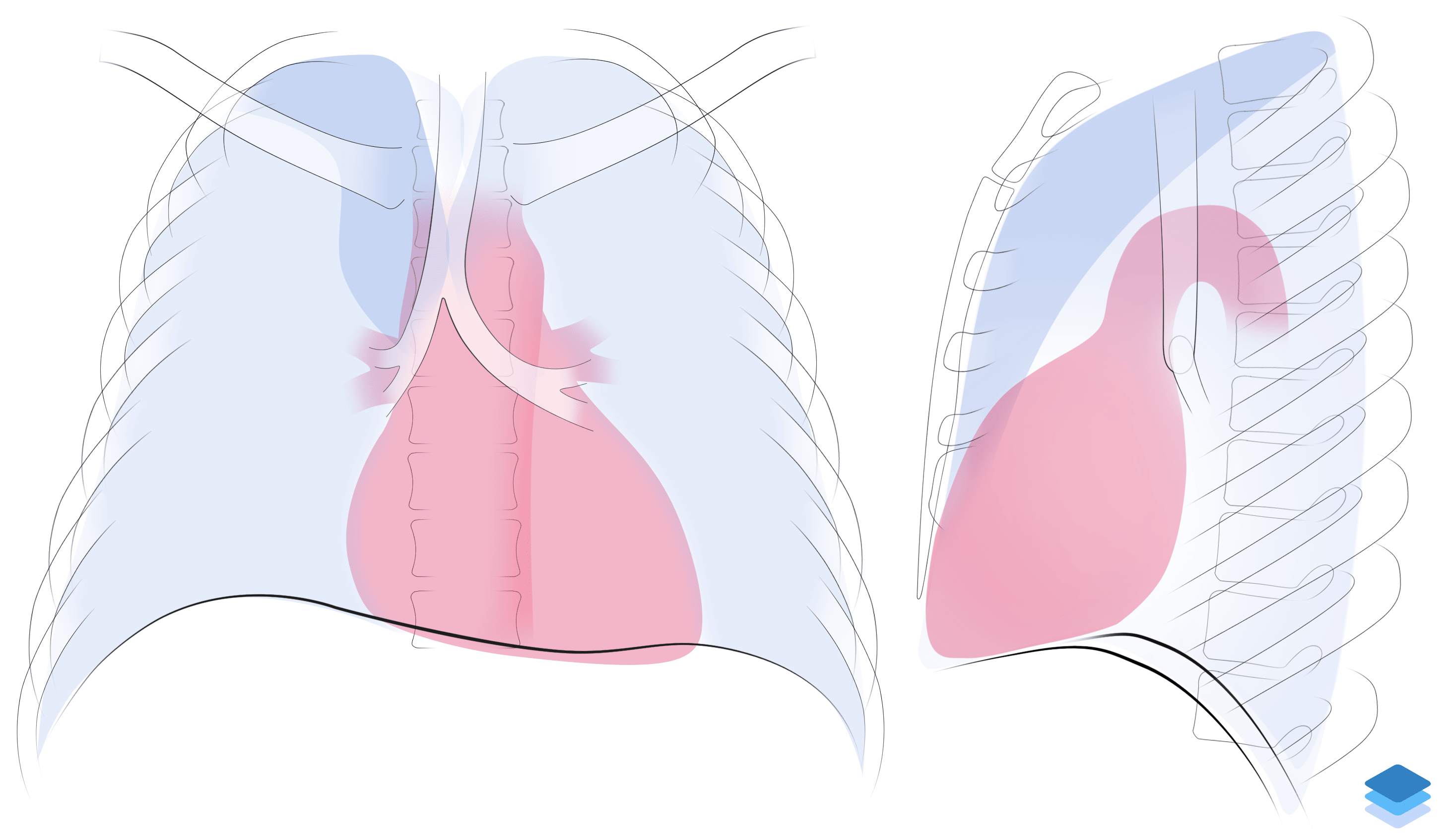 Right upper lobe collapse. Illustration by Valerie George, MD