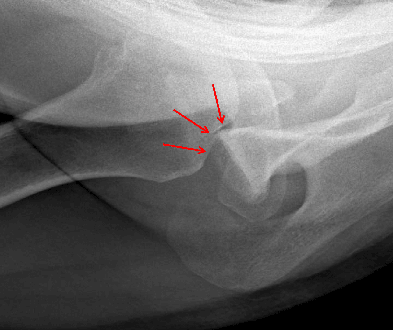 Acute Hill-Sachs impaction fracture along the posterolateral humeral head (red arrows).