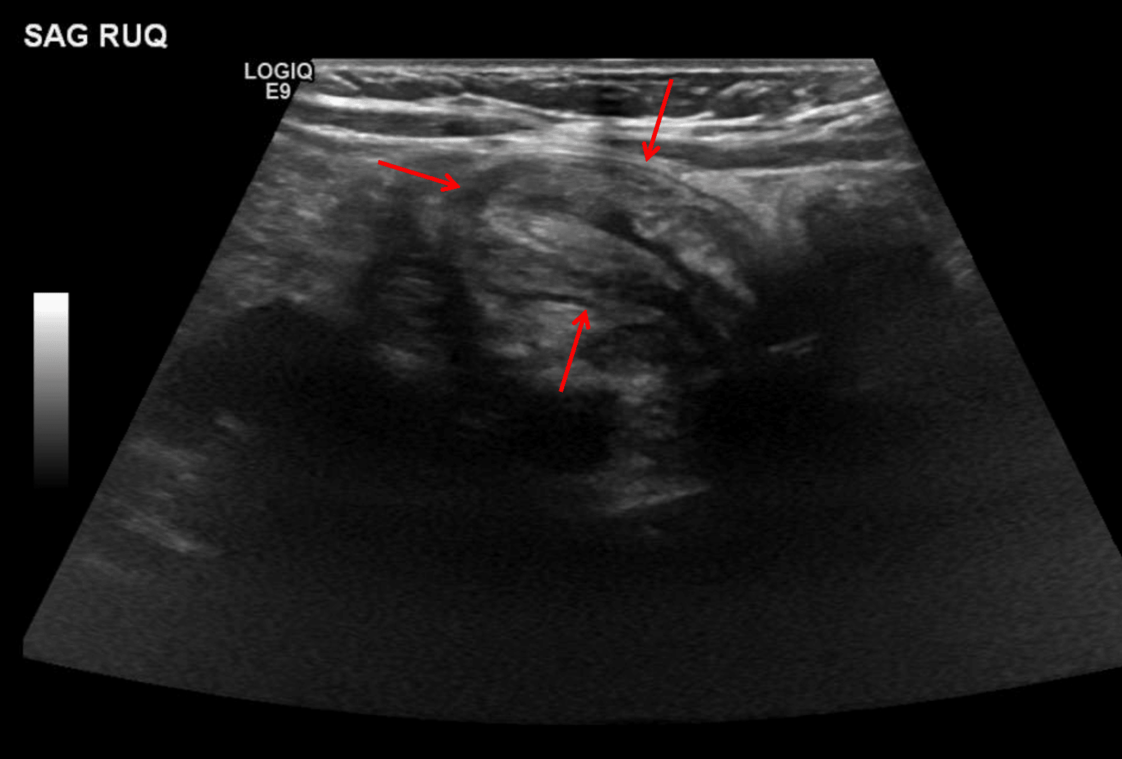 Longitudinal view of an ileocolic intussusception in this patient (red arrows).