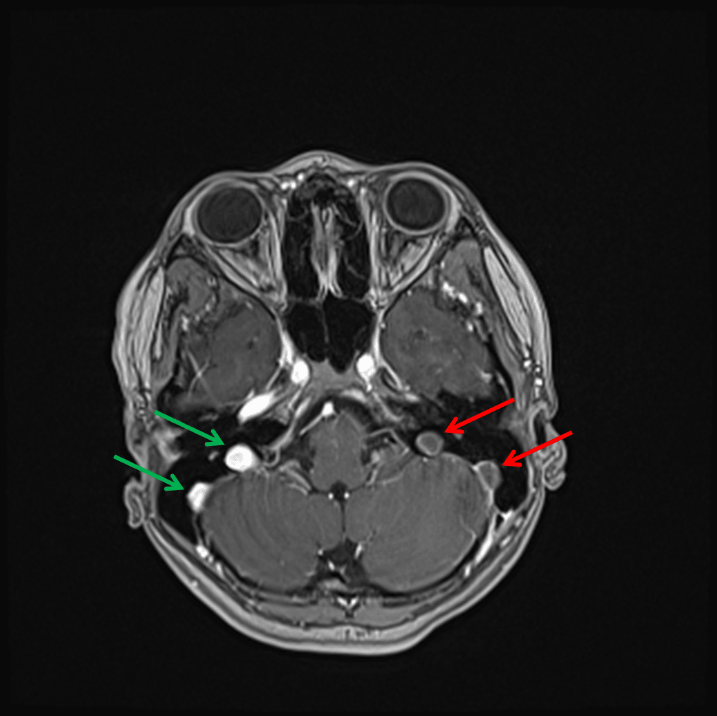 Nonopacification of the left sigmoid sinus and left jugular bulb (red arrows) in contrast to the normally opacified structures on the right (green arrows) on this postcontrast image.