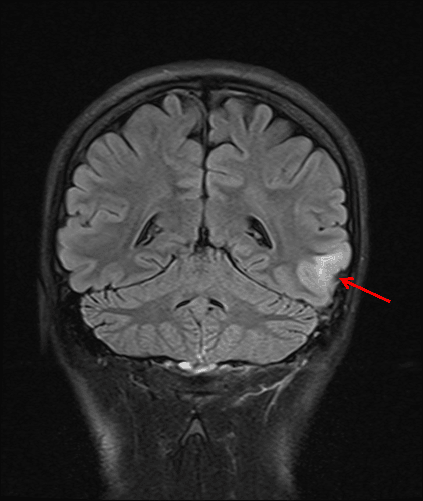 Small area of FLAIR signal hyperintensity in the left middle temporal gyrus (red arrow).