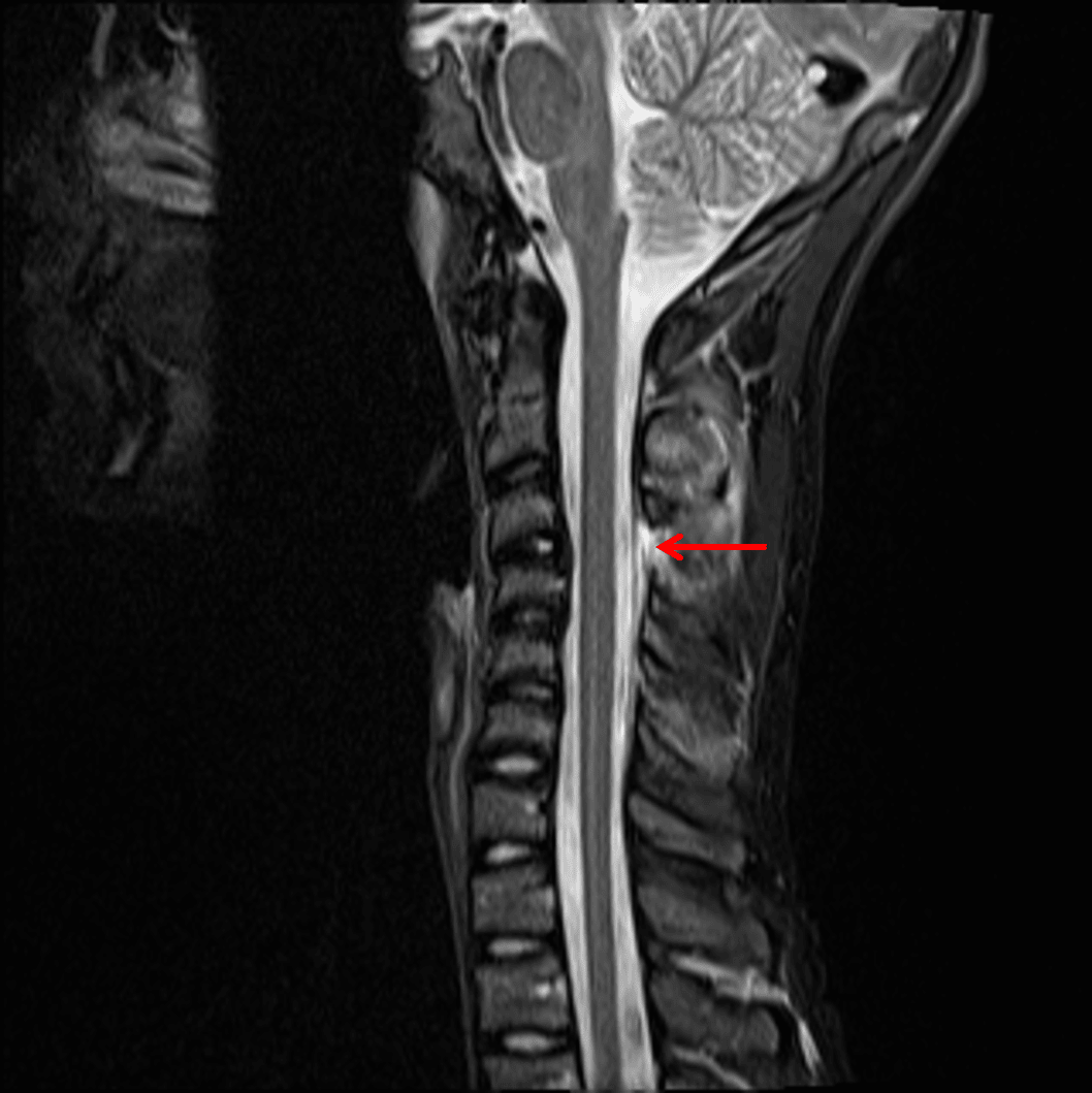 Cervical Ligamentous Injury 1.1