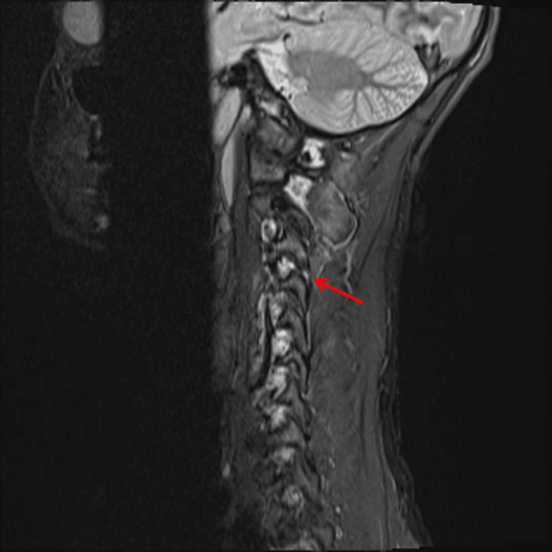 Cervical Ligamentous Injury 1.2