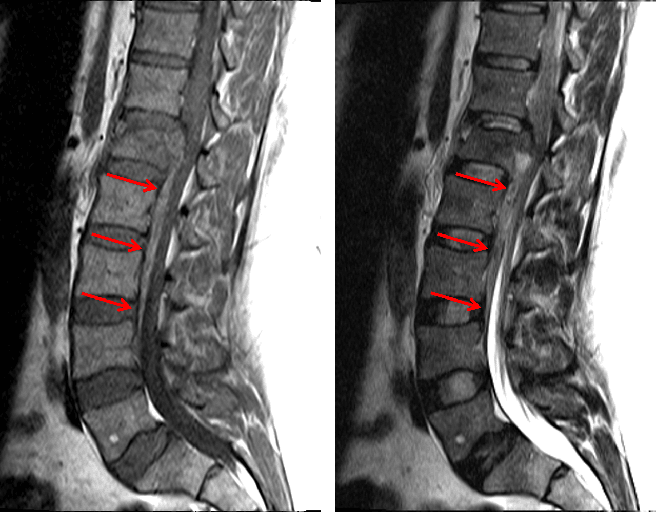 Ventral epidural collection (red arrows) that is hyperintense on T1-weighted images (left) and iso- to mildly hyperintense on T2-weighted images (right) consistent with an epidural hematoma.