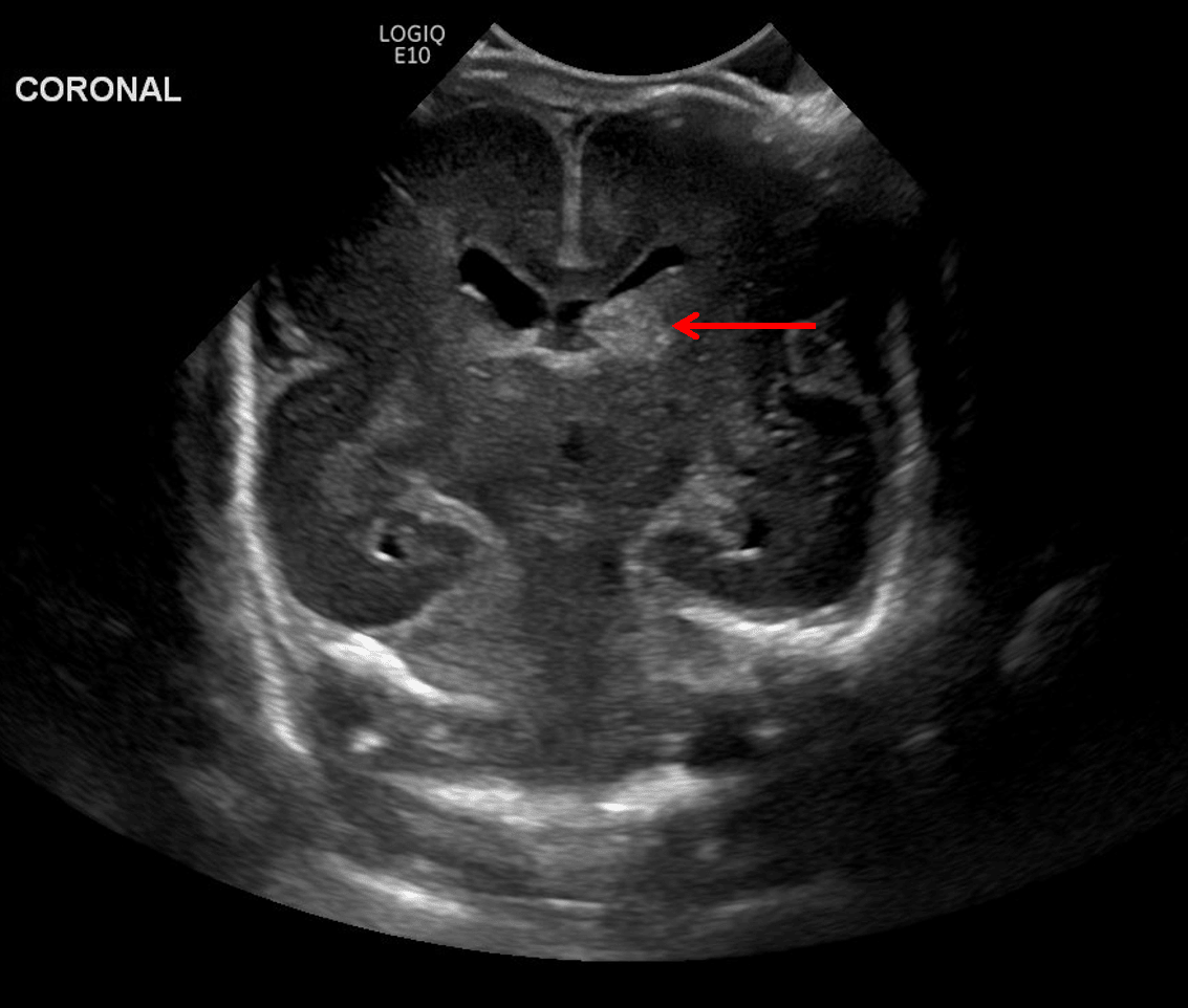 Rounded echogenic area in the left caudothalamic groove (red arrow) consistent with germinal matrix hemorrhage.