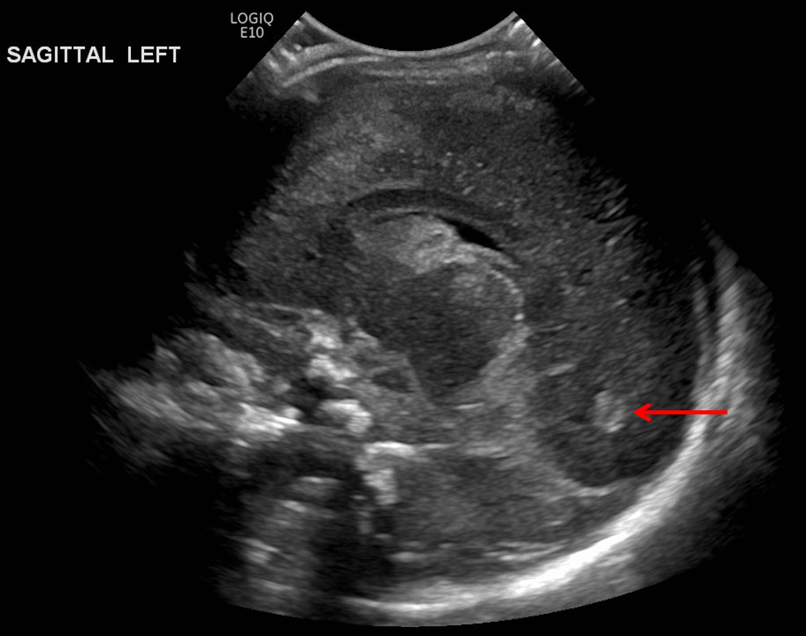 Echogenic material layering in the occipital horn of the left lateral ventricle (red arrow) consistent with intraventricular hemorrhage.