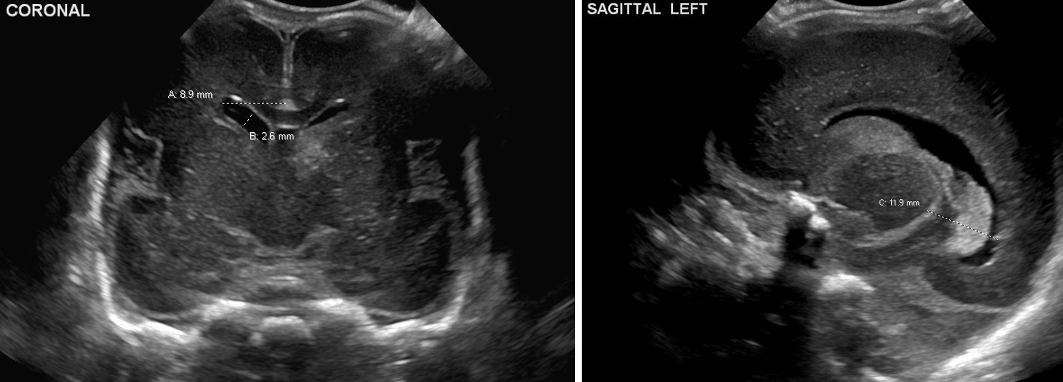 Example measurements of the ventricular index (A), anterior horn width (B), and thalamo-occipital distance (C).