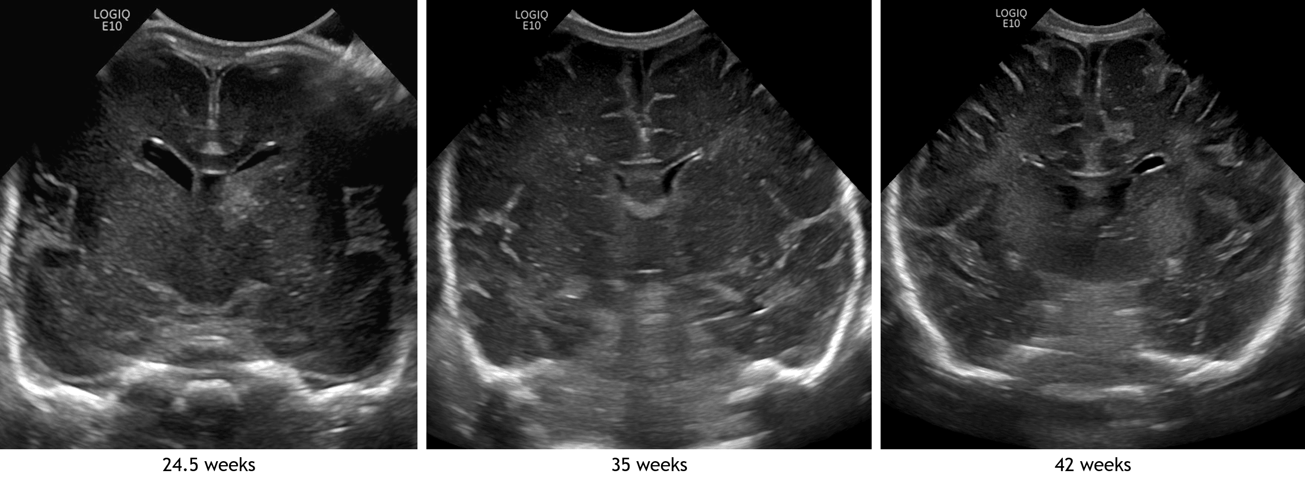 Coronal image in this patient compared with images from different patients imaged at 35 and 42 weeks. Notice how the echogenic sulci become deeper and more numerous with increasing patient age.