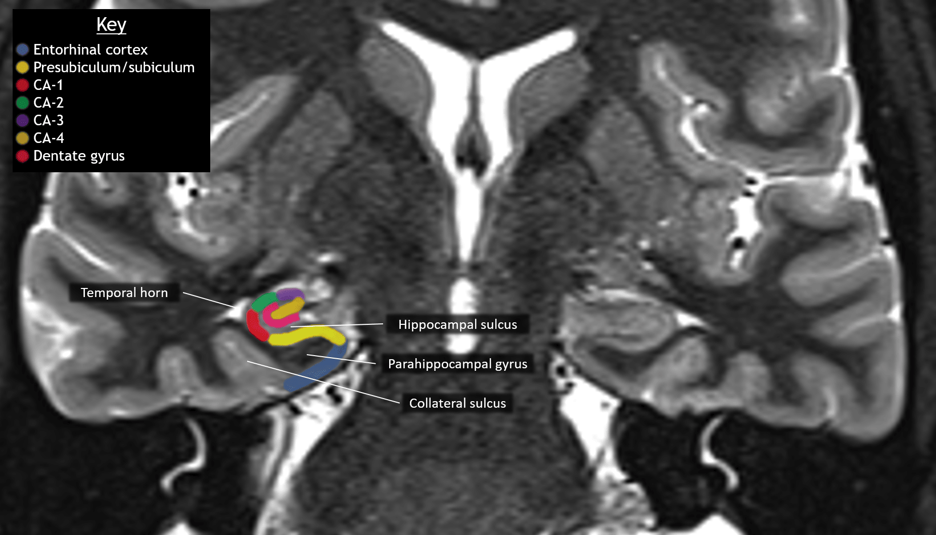 Anatomy of the mesial temporal structures on a coronal STIR image from a young, healthy patient.