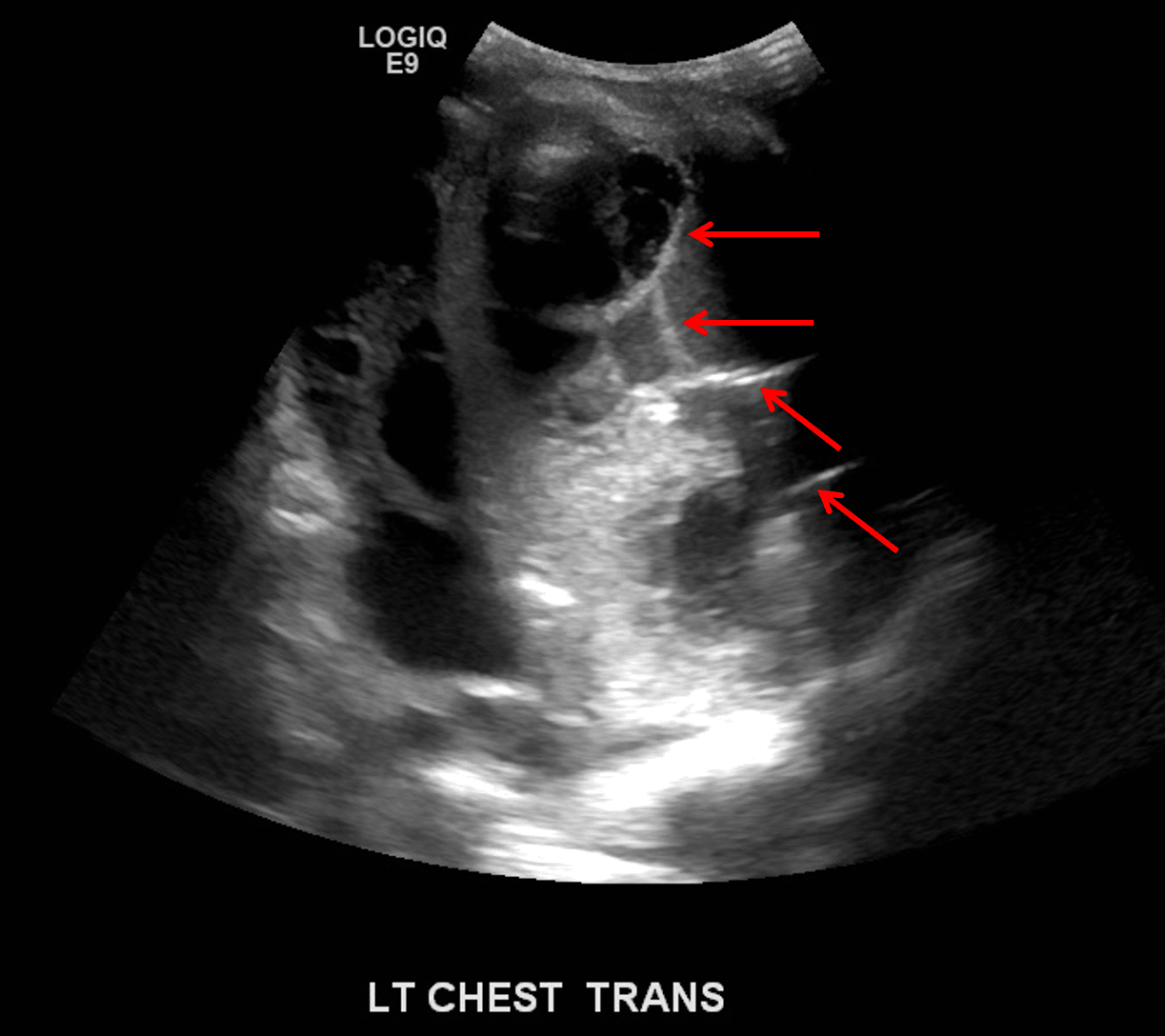 Complex left pleural fluid collection with echogenic internal septations (red arrows), concerning for an empyema.