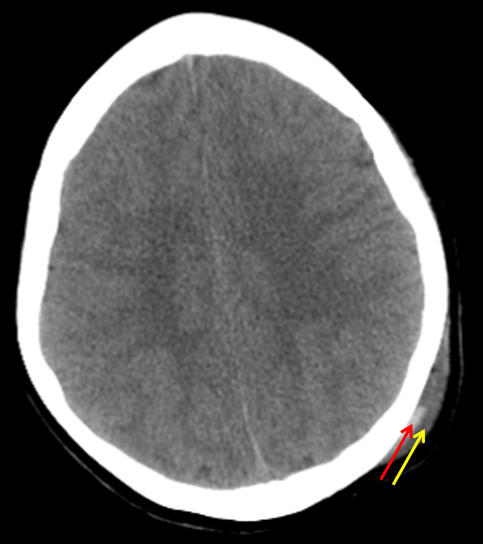 Scalp hematoma with distinct deep (red arrow) and superficial (yellow arrow) components. The deep component contains layering hyperdense blood products and is likely subgaleal in location.