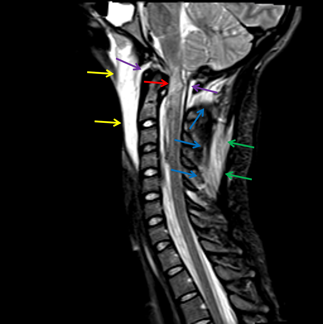 Atlantooccipital Dissociation 1.1