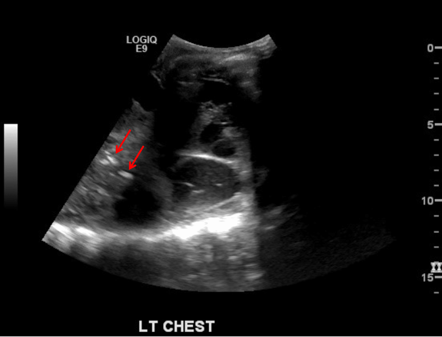 Multiple punctate and linear echogenic foci in the left lung (red arrows), consistent with air bronchograms.