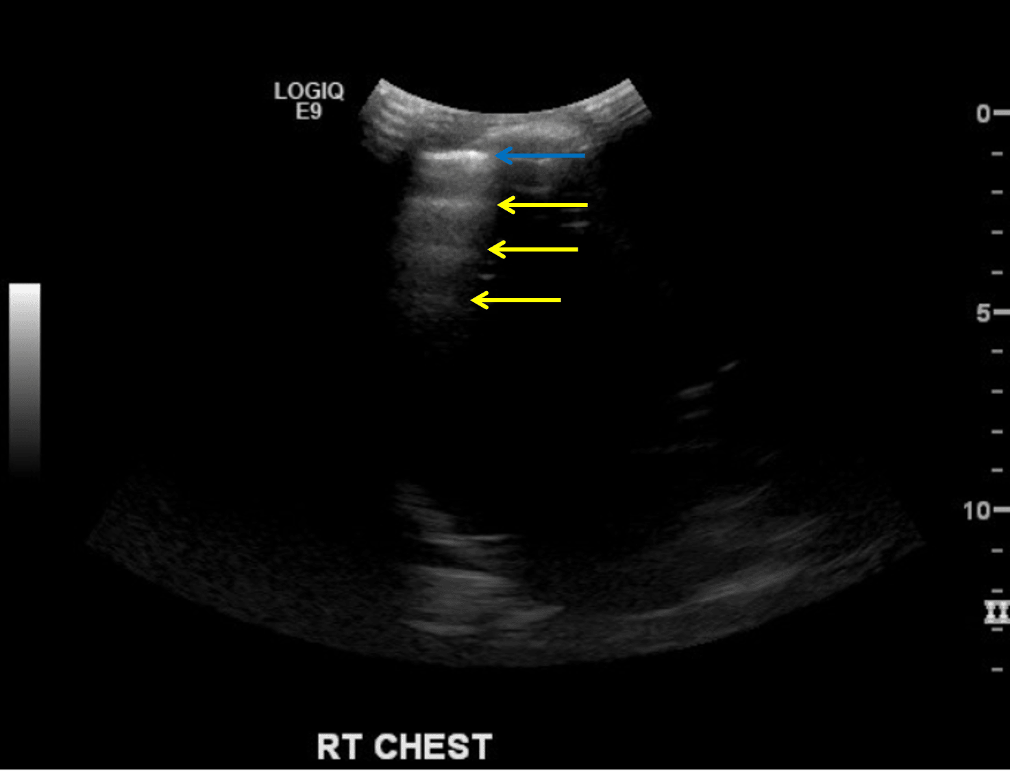 Ultrasound evaluation of the normal right lung in this patient shows the pleural line (blue arrow) with multiple ripple-like echogenic lines extending deep (yellow lines), which are referred to as A-lines.