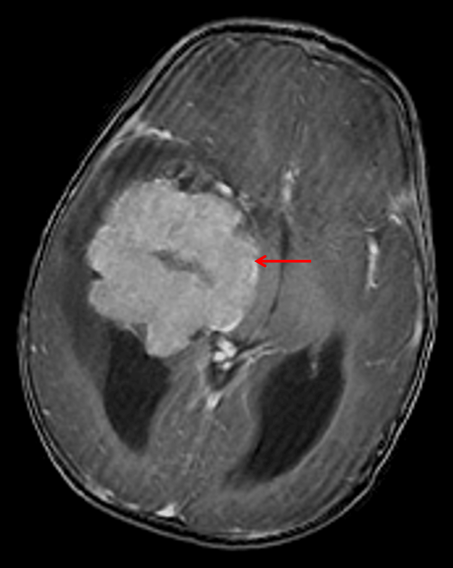 Avidly enhancing mass centered in the temporal horn of the right lateral ventricle (red arrow), consistent with a choroid plexus tumor.