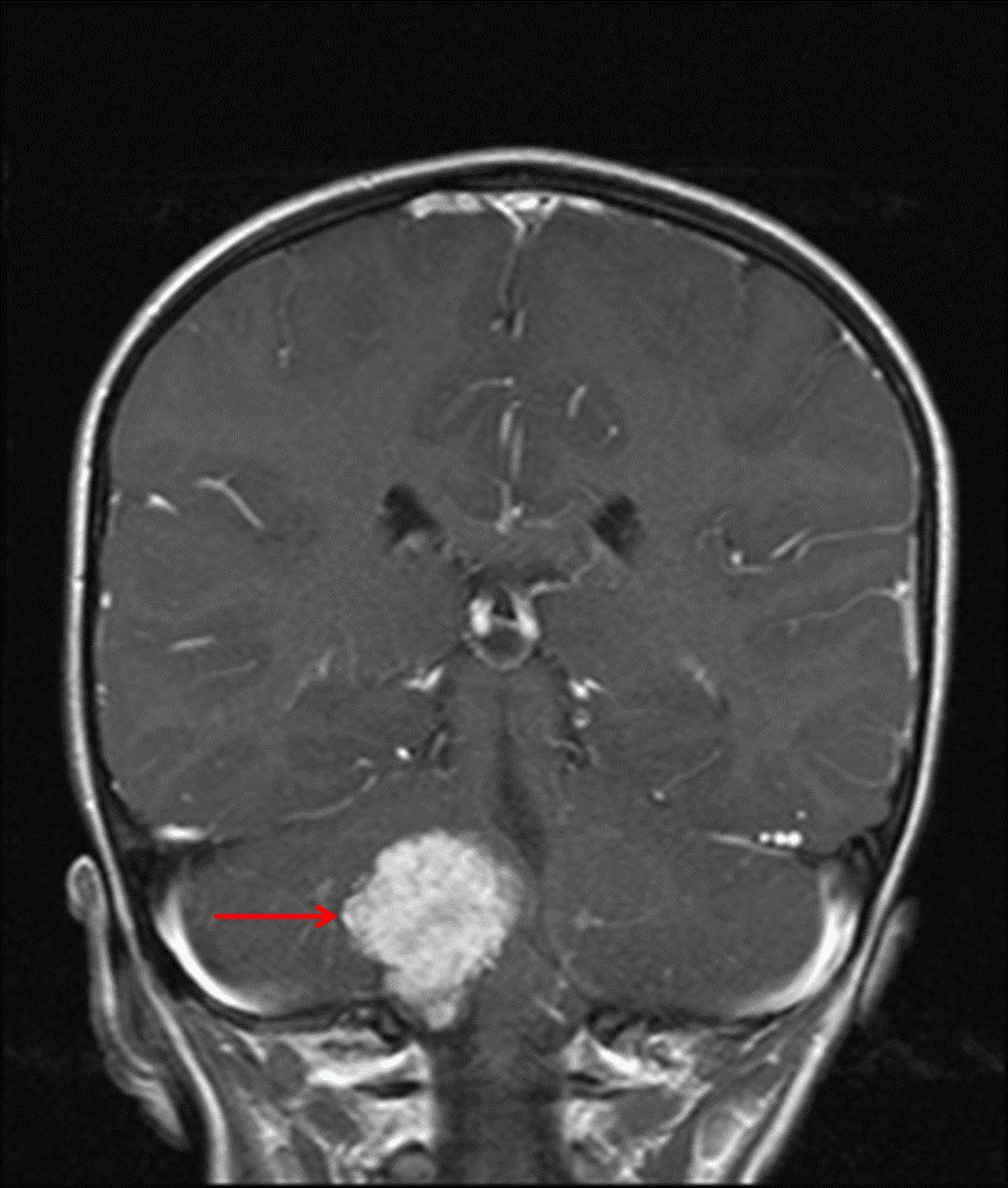 Avidly enhancing mass centered in the right foramen of Luschka (red arrow), consistent with a choroid plexus tumor.
