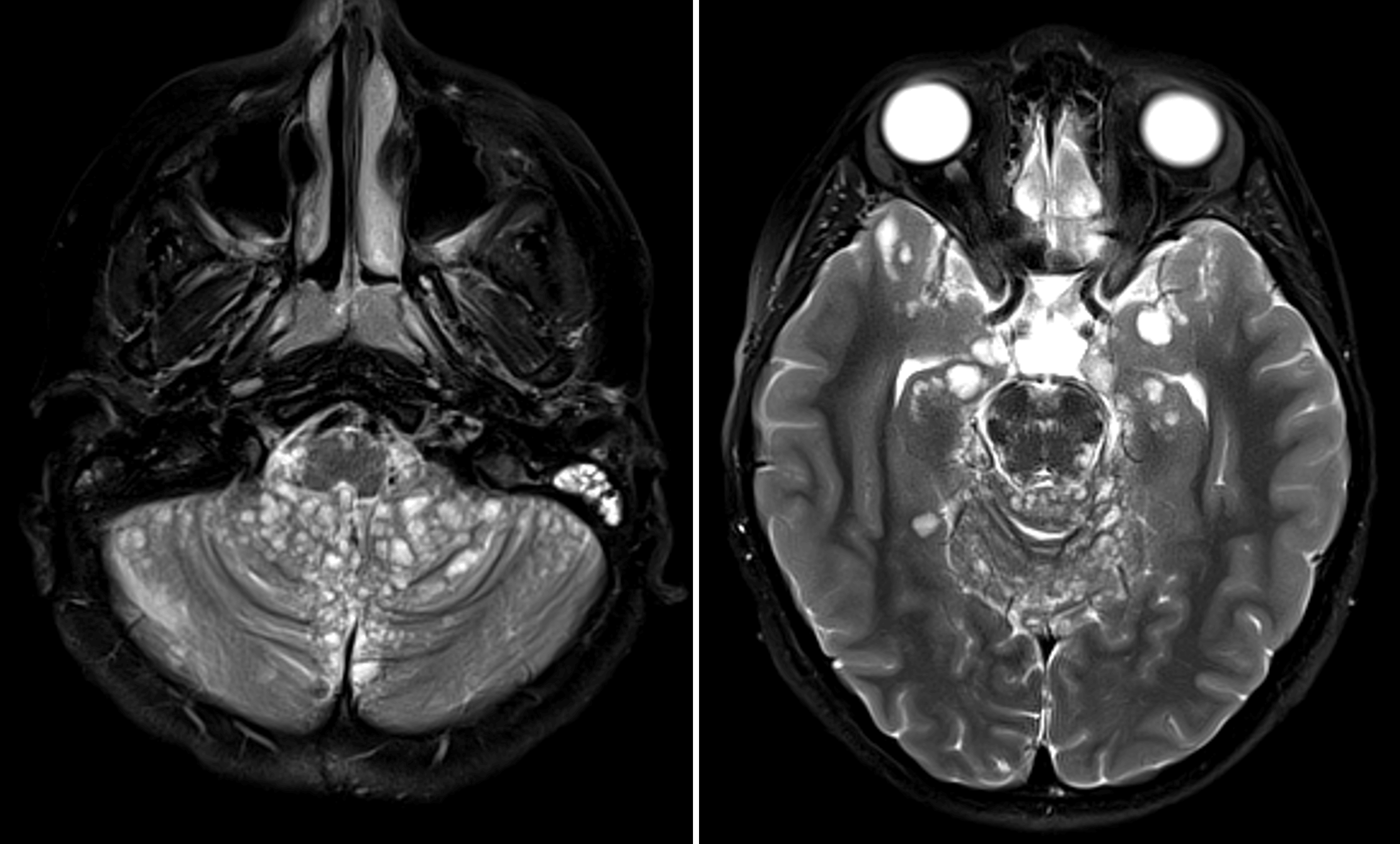 Numerous subpial cysts coating the brainstem, cerebellum, and inferior aspects of the supratentorial structures, which is a characteristic imaging appearance for diffuse leptomeningeal glioneuronal tumor.