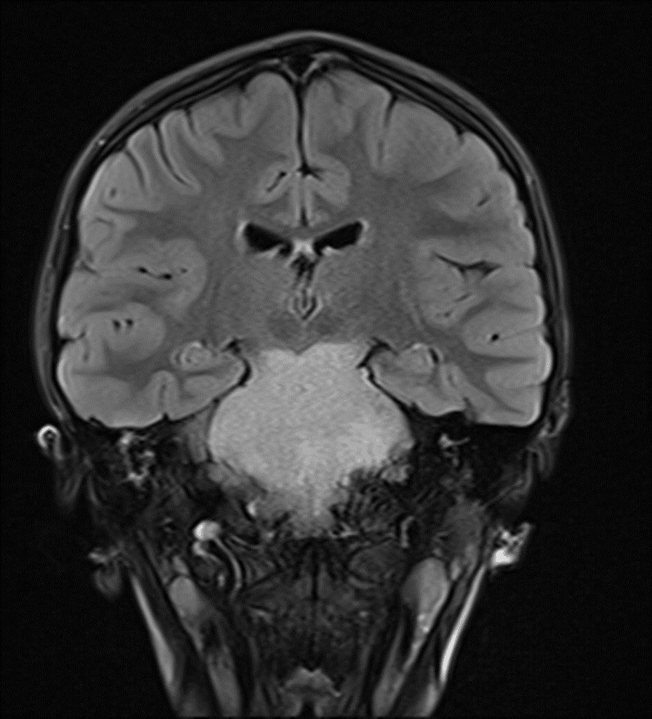 Homogeneous FLAIR hyperintense mass involving the entire pons and extending into the midbrain and medulla, which is a classic imaging appearance for a diffuse midline glioma.
