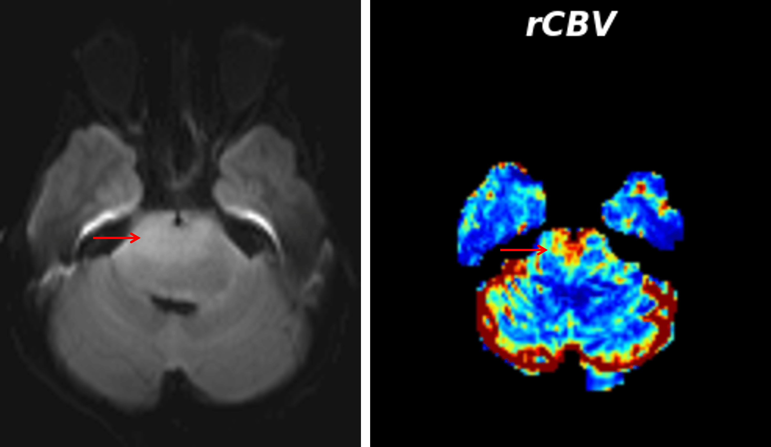 Area of mild restricted diffusion in the ventral pons, which demonstrated elevated cerebral blood volume on perfusion analysis (red arrows).