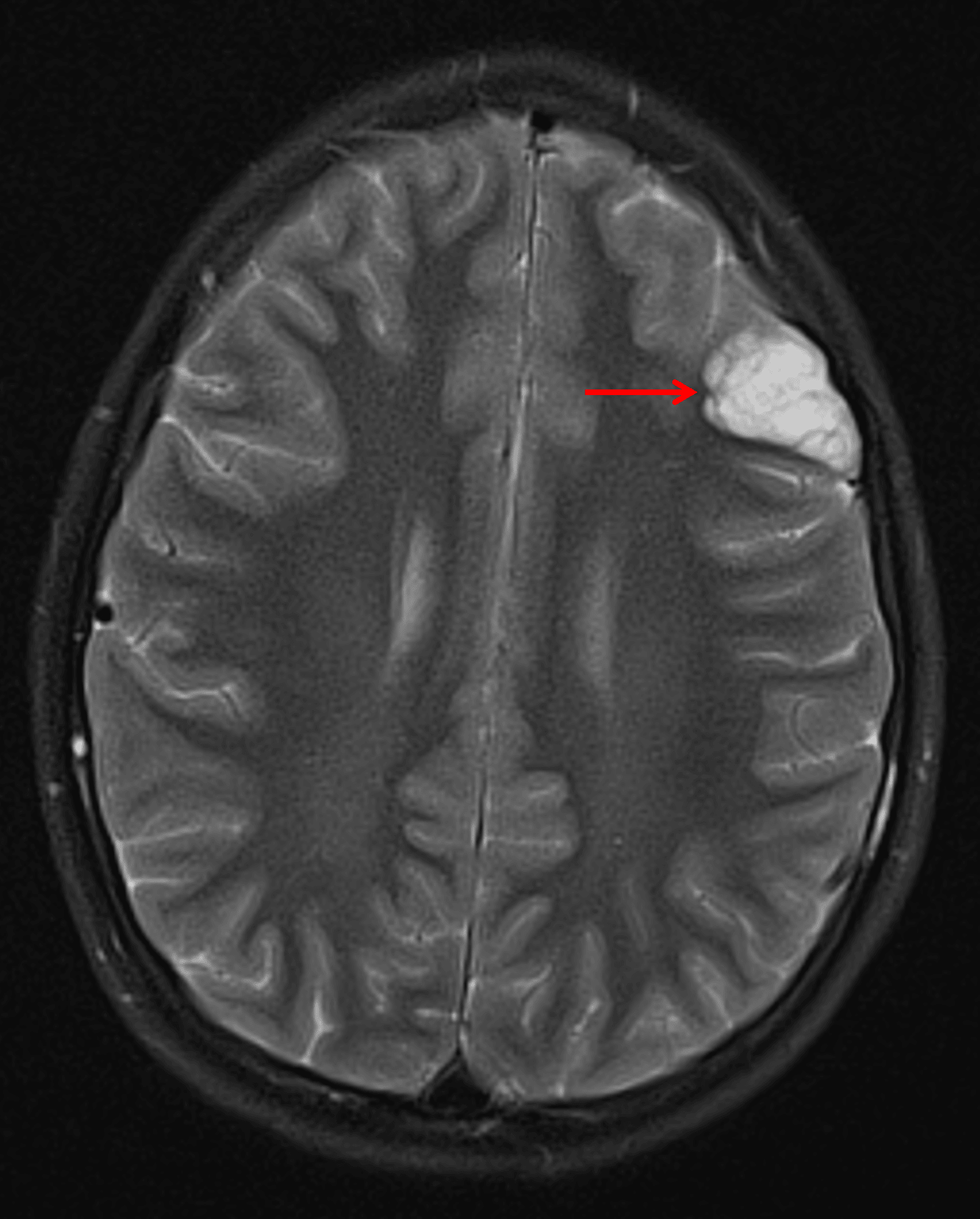 Wedge-shaped, cortically-based, bubbly T2 hyperintense lesion in the left frontal lobe (red arrow) consistent with a DNET.