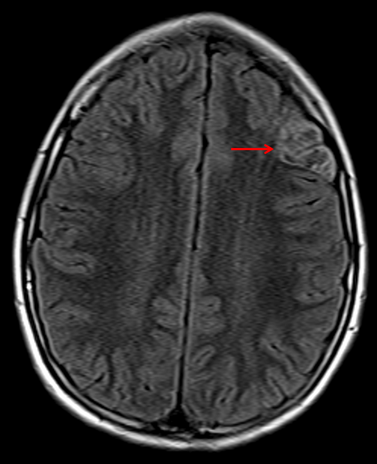 Note the heterogeneous internal FLAIR signal with a preserved hyperintense rim (red arrow).