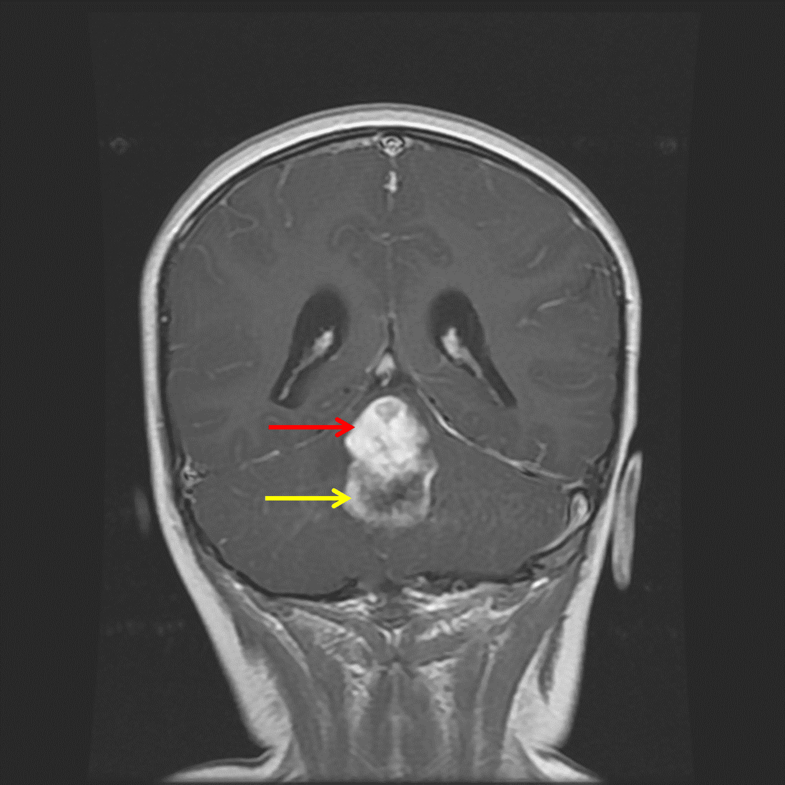 Midline posterior fossa mass with a superior solid component (red arrow) and inferior peripherally-enhancing cystic component (yellow arrow).