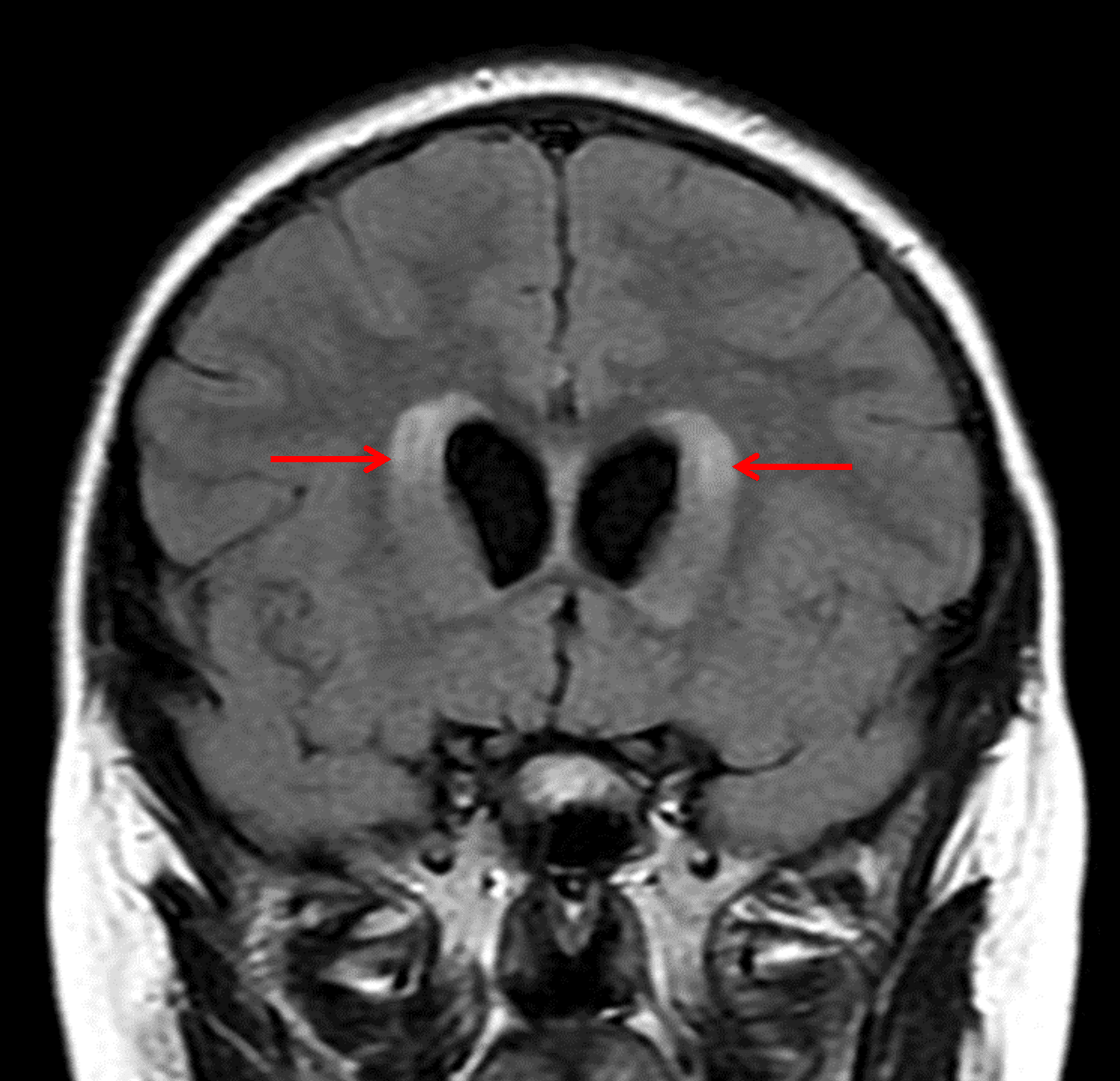 Associated obstructive hydrocephalus with subependymal edema (red arrows).