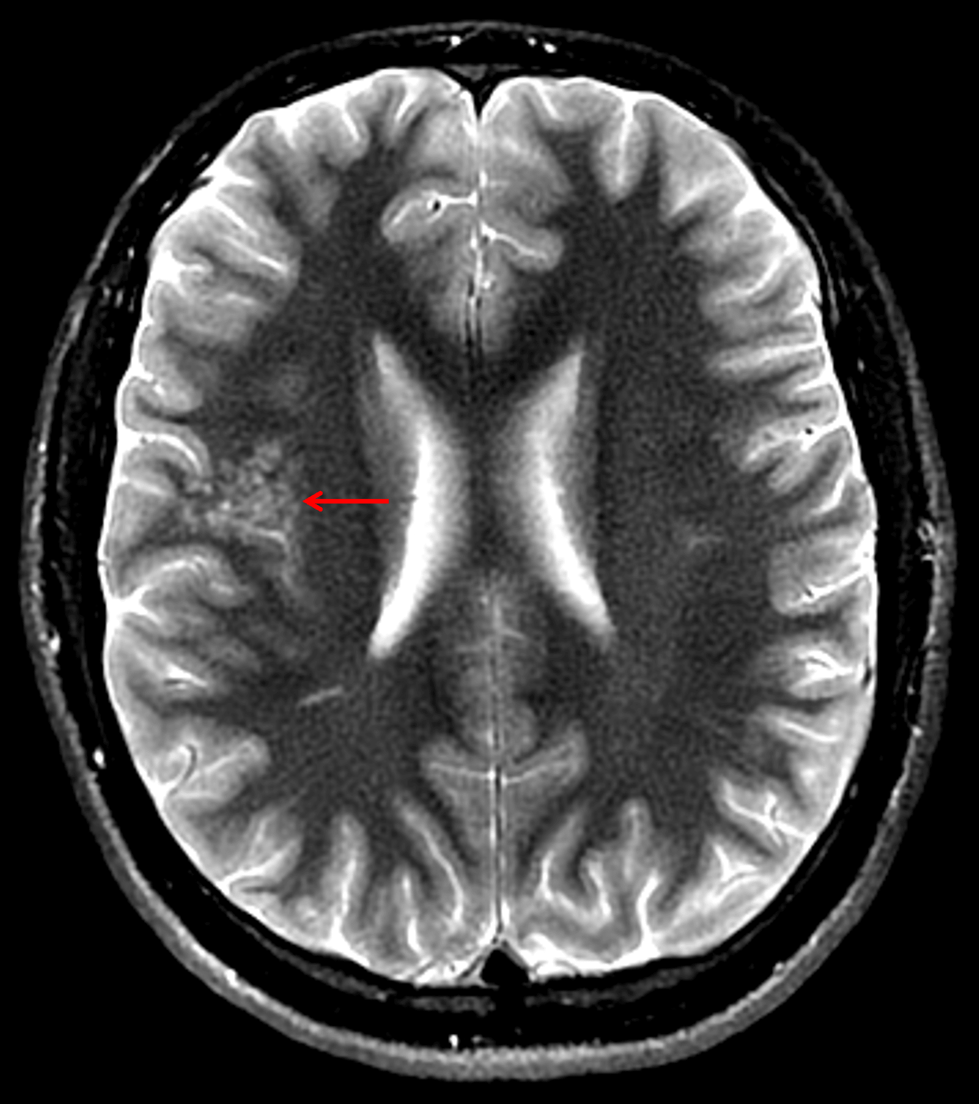 Clustered T2 hyperintense cystic structures in the subcortical white matter of the right frontal operculum and superior insula (red arrow) with normal appearance of the overlying cortex which is a typical appearance for MVNT.
